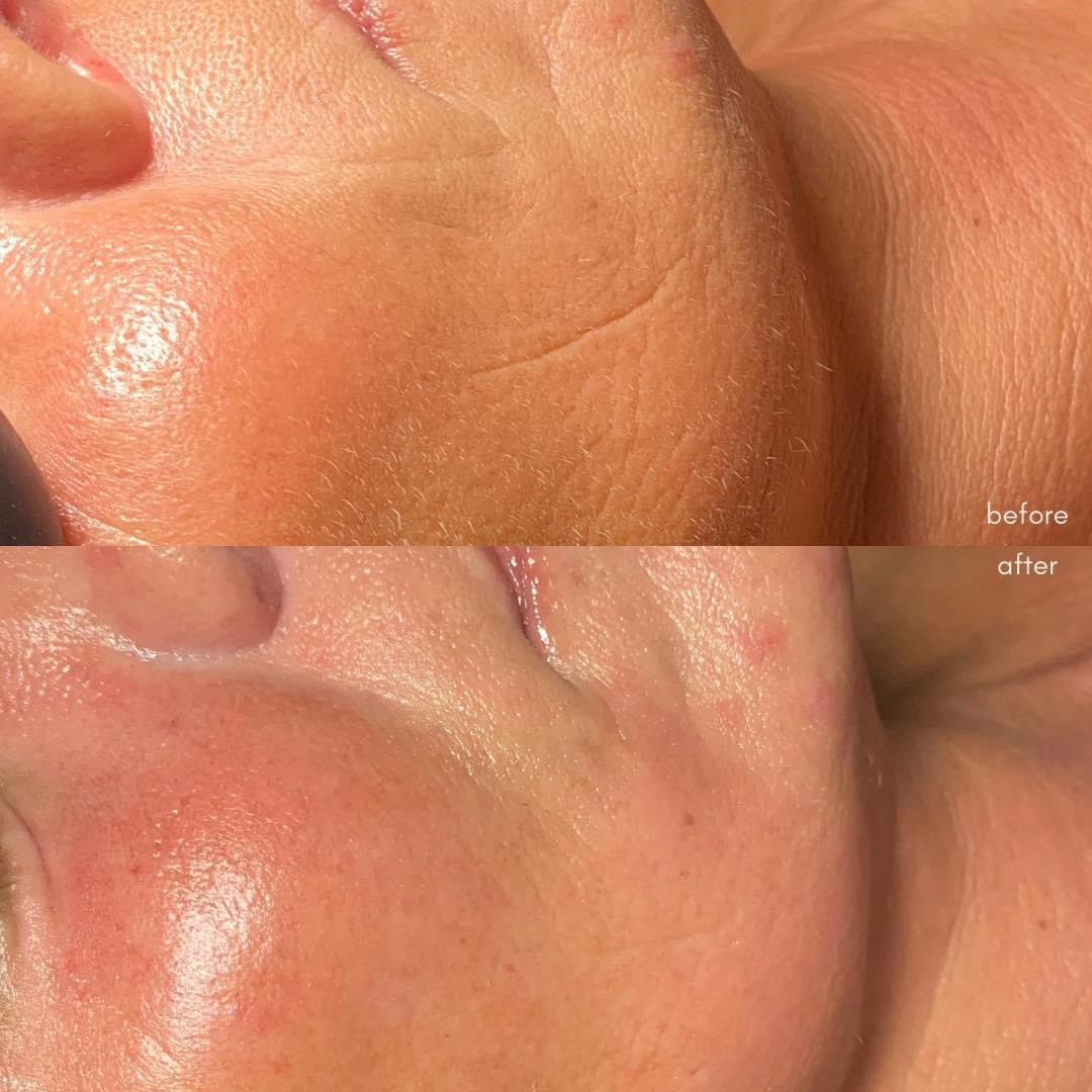Facial treatment cheek result.