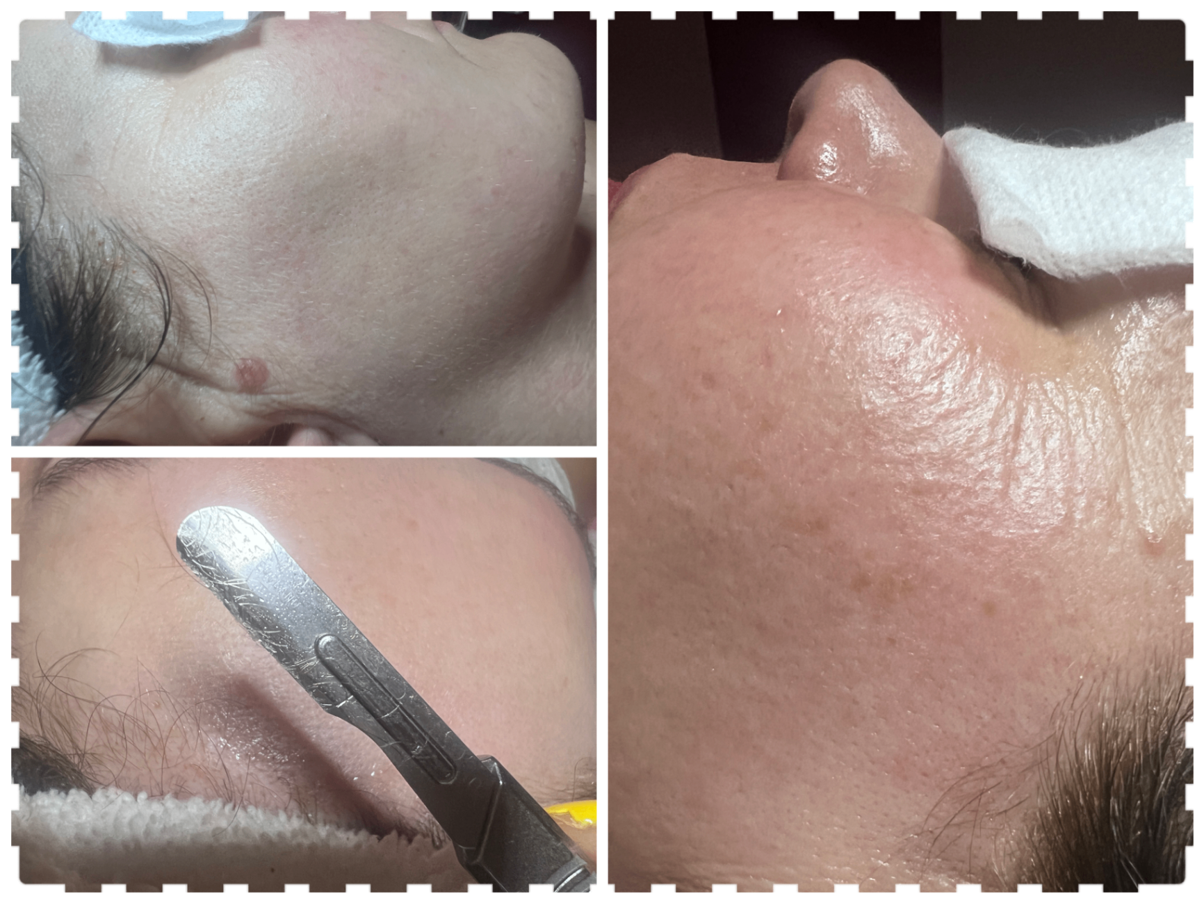 Dermaplaning facial glow result.
